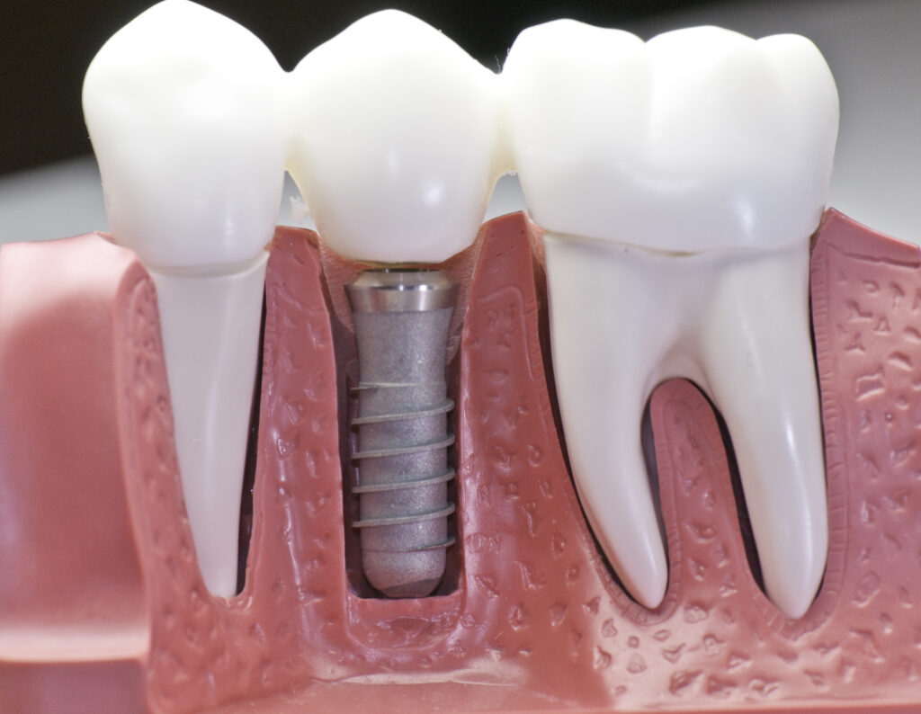 Dental Implants Tucson