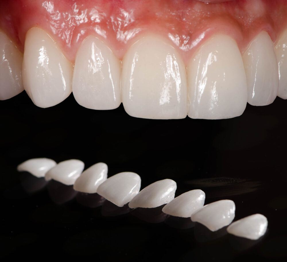 Veneers Tucson